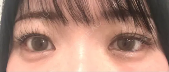目尻切開 / タレ目形成・グラマラスライン（埋没） / ピコスポット LOUIS CLINIC 二子玉川院【ルイクリニック】 AFTER メイン用