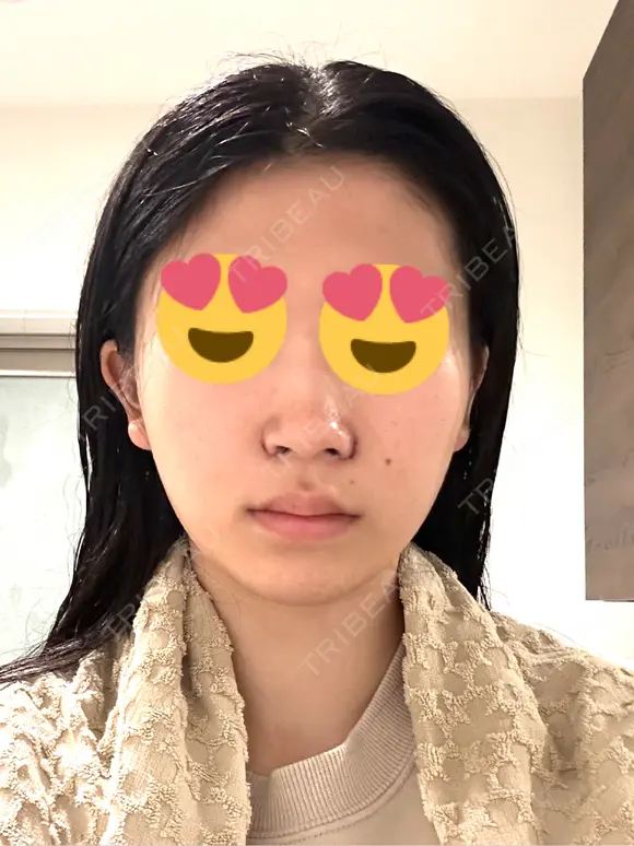 小鼻縮小（切開） くさのたろうクリニック DAY 1 メイン用