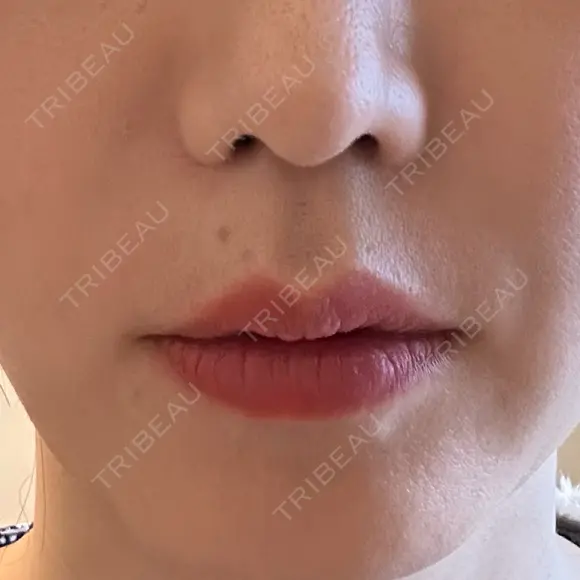 ボトックス（あご） / ボトックス（口角） / ボトックス（眉間） / ボトックス（額） / ボトックス（人中） BiBiクリニック AFTER メイン用