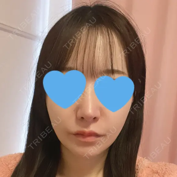 鼻尖形成（切開） / 小鼻縮小（切開） / ワシ鼻修正・ハンプ切除 / 鼻柱下降・鼻唇角形成（猫手術） ASTRA BEAUTY CLINIC AFTER メイン用