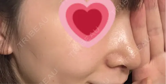 鼻尖形成（切開） / 小鼻縮小（切開） / 軟骨移植 / 鼻修正 / 鼻柱下降・鼻唇角形成（猫手術） R Beauty CLINIC 大阪院 AFTER メイン用