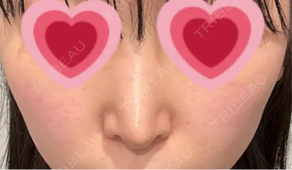 鼻尖形成（切開） / 小鼻縮小（切開） / 軟骨移植 / 鼻修正 / 鼻柱下降・鼻唇角形成（猫手術） R Beauty CLINIC 大阪院 DAY 175 メイン用