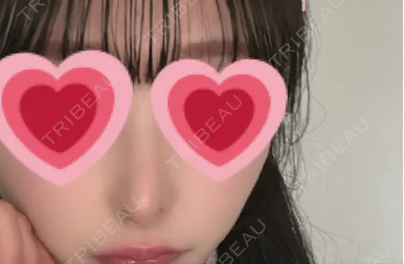 鼻尖形成（切開） / 小鼻縮小（切開） / 軟骨移植 / 鼻修正 / 鼻柱下降・鼻唇角形成（猫手術） R Beauty CLINIC 大阪院 DAY 175 メイン用