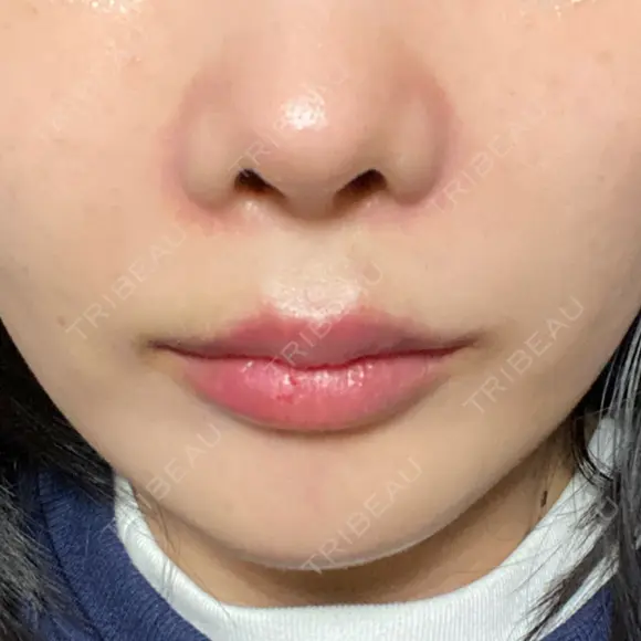 ボトックス（エラ・小顔） / ヒアルロン酸注入（唇） ルラ美容クリニック 名古屋栄院 / ルラスキンクリニック 名古屋栄院 DAY 33 メイン用