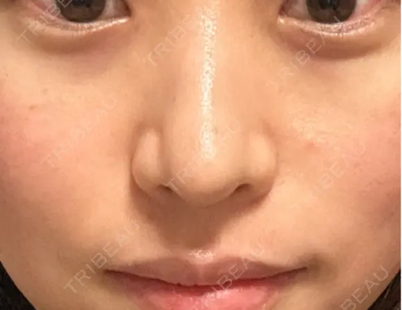 軟骨移植 / 目元修正 / 自然癒着法 / 鼻尖形成（非切開） eクリニック 福岡院 DAY 14 メイン用