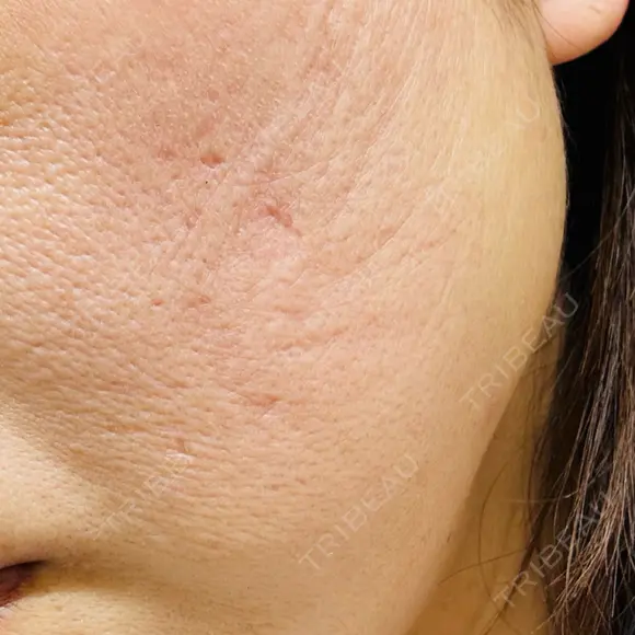 その他（輪郭） ルラ美容クリニック 大宮院 / ルラスキンクリニック 大宮院 DAY 4 メイン用