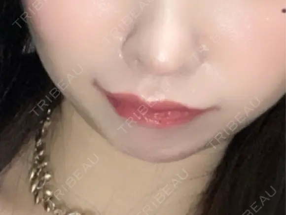 ヒアルロン酸注入（唇） / ヒアルロン酸注入（鼻翼基部） BiBiクリニック DAY 8 メイン用