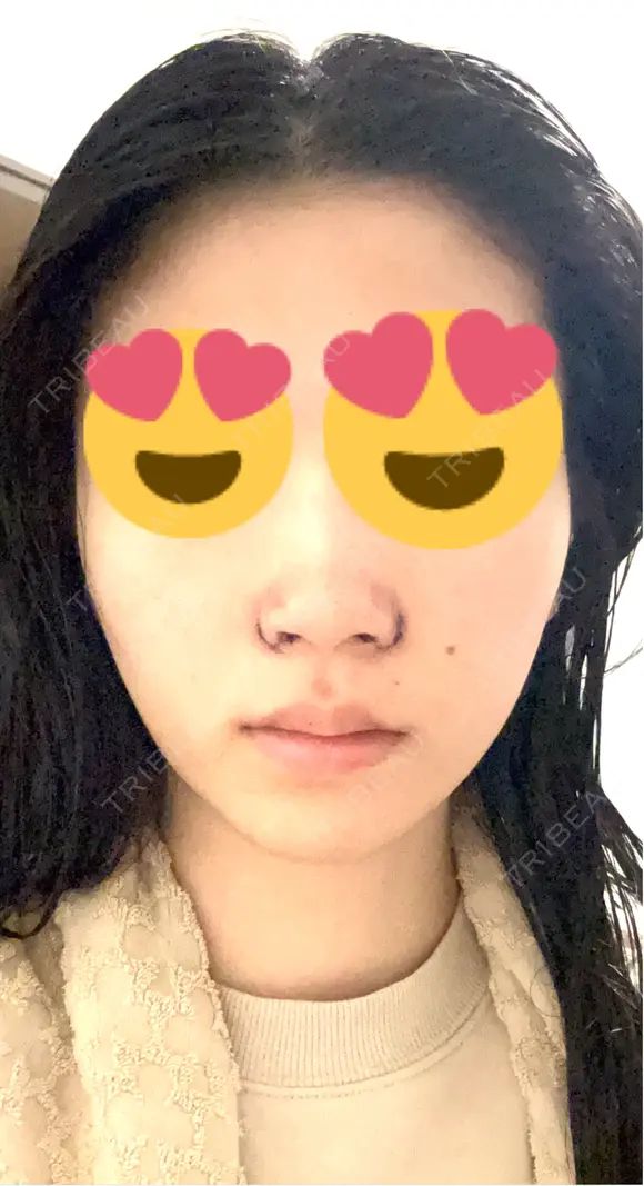 小鼻縮小（切開） くさのたろうクリニック DAY 2 メイン用