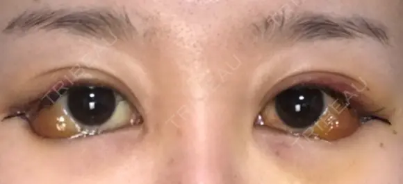 目尻切開 / 目尻靭帯移動 FROM B整形外科 (旧バウム整形外科) DAY 5 メイン用