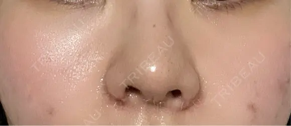 鼻尖形成（切開） / 小鼻縮小（切開） / 軟骨移植 / 鼻柱下降・鼻唇角形成（猫手術） / その他（鼻） 東京シンデレラ美容外科 池袋院 DAY 3 メイン用