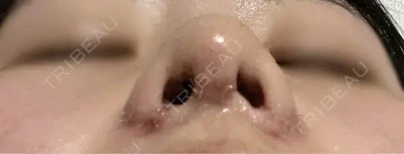 鼻尖形成（切開） / 小鼻縮小（切開） / 軟骨移植 / 鼻柱下降・鼻唇角形成（猫手術） / その他（鼻） 東京シンデレラ美容外科 池袋院 DAY 3 メイン用