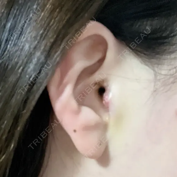 鼻尖形成（切開） / 小鼻縮小（切開） / 軟骨移植 / 鼻柱下降・鼻唇角形成（猫手術） / その他（鼻） 東京シンデレラ美容外科 池袋院 DAY 3 メイン用