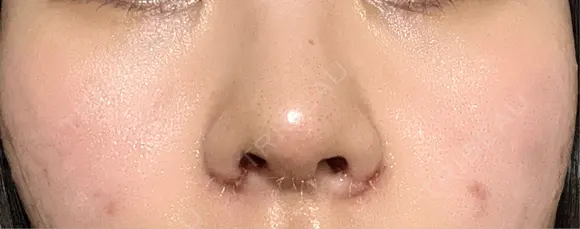 鼻尖形成（切開） / 小鼻縮小（切開） / 軟骨移植 / 鼻柱下降・鼻唇角形成（猫手術） / その他（鼻） 東京シンデレラ美容外科 池袋院 AFTER メイン用