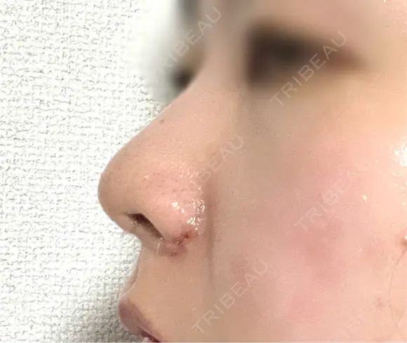 鼻尖形成（切開） / 小鼻縮小（切開） / 軟骨移植 / 鼻柱下降・鼻唇角形成（猫手術） / その他（鼻） 東京シンデレラ美容外科 池袋院 DAY 4 メイン用