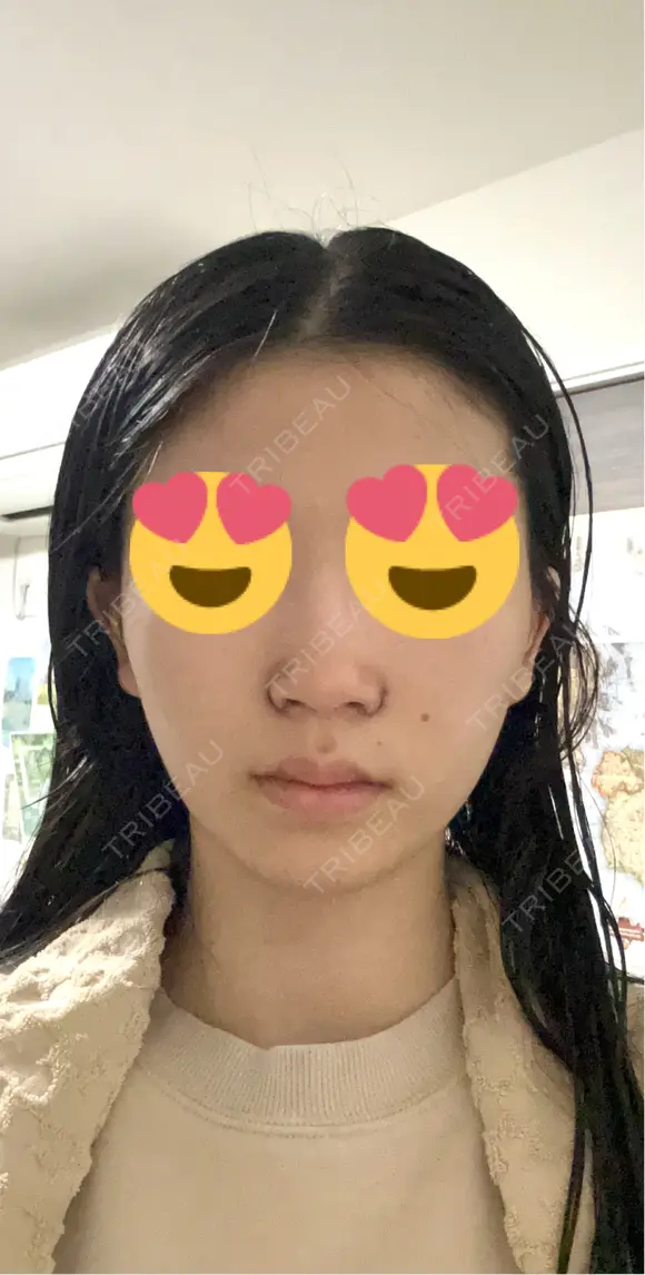 小鼻縮小（切開） くさのたろうクリニック DAY 3 メイン用