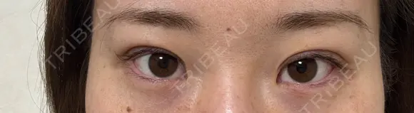 二重埋没 東京シンデレラ美容外科 池袋院 DAY 0 メイン用