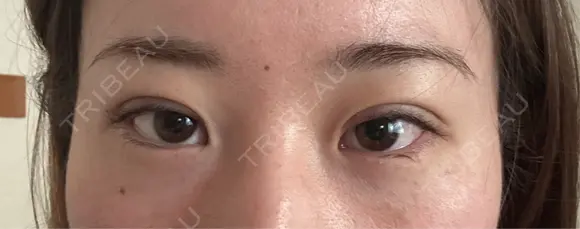 二重埋没 東京シンデレラ美容外科 池袋院 DAY 1 メイン用