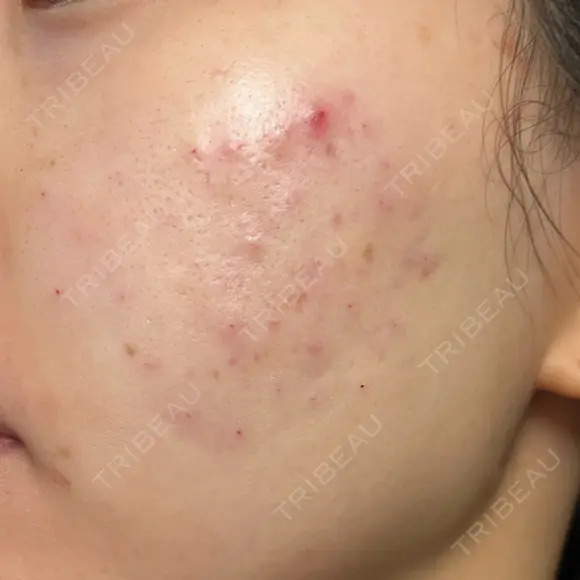 肌育注射（ジュベルックなど） Natural Skin Clinic 自由ヶ丘院 DAY 0 メイン用