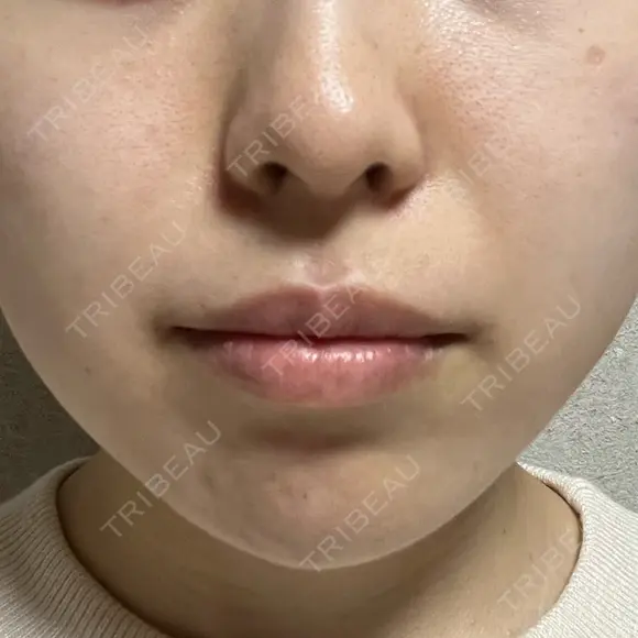 ヒアルロン酸注入（あご） / ヒアルロン酸注入（唇） / ボトックス（口角） フィラークリニック 大阪梅田院 DAY 0 メイン用