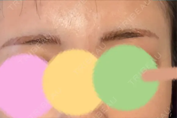 アートメイク（眉） 表参道メディカルクリニック 福岡天神院 AFTER メイン用