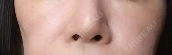 ヒアルロン酸注入（頬） 目白ホワイトクリニック DAY 0 メイン用