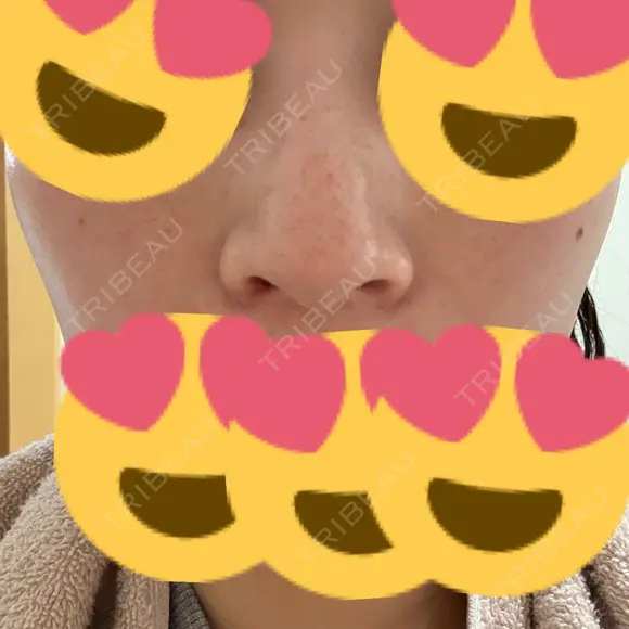 小鼻縮小（切開） アネシス美容クリニック DAY 20 メイン用