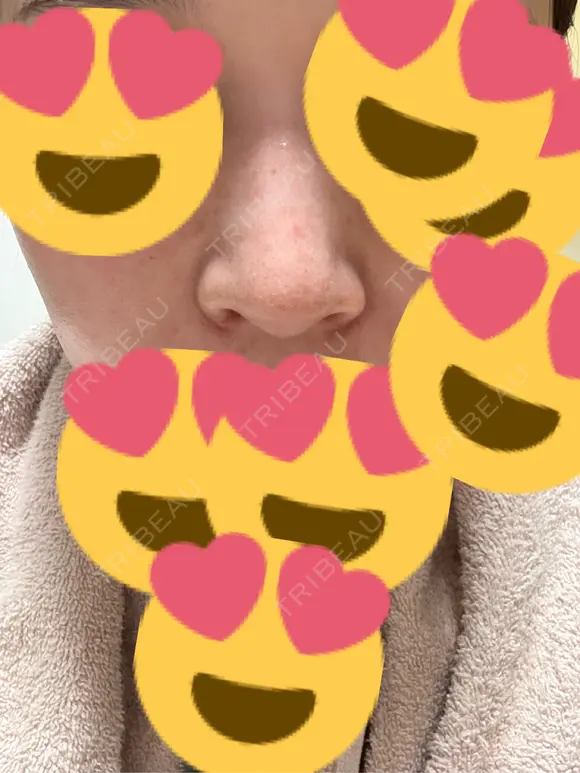 小鼻縮小（切開） アネシス美容クリニック DAY 20 メイン用