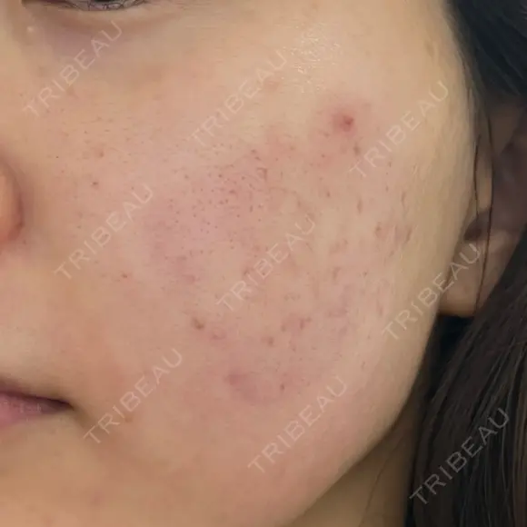 肌育注射（ジュベルックなど） Natural Skin Clinic 自由ヶ丘院 DAY 1 メイン用