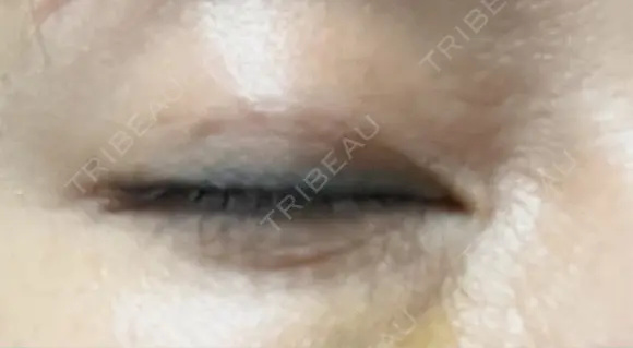 二重埋没 / ヒアルロン酸注入（目の下） アーティスクリニック 博多 DAY 12 メイン用