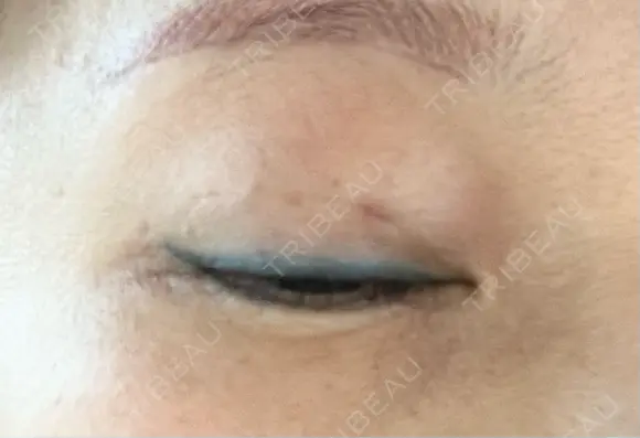 二重埋没 / ヒアルロン酸注入（目の下） アーティスクリニック 博多 DAY 22 メイン用