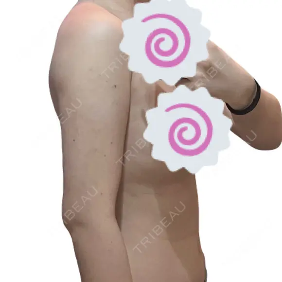 糸リフト / 脂肪吸引（顔） / 脂肪吸引（二の腕） / ワキ汗治療（切開） / 脂肪吸引注射（顔） ICON CLINIC DAY 17 メイン用