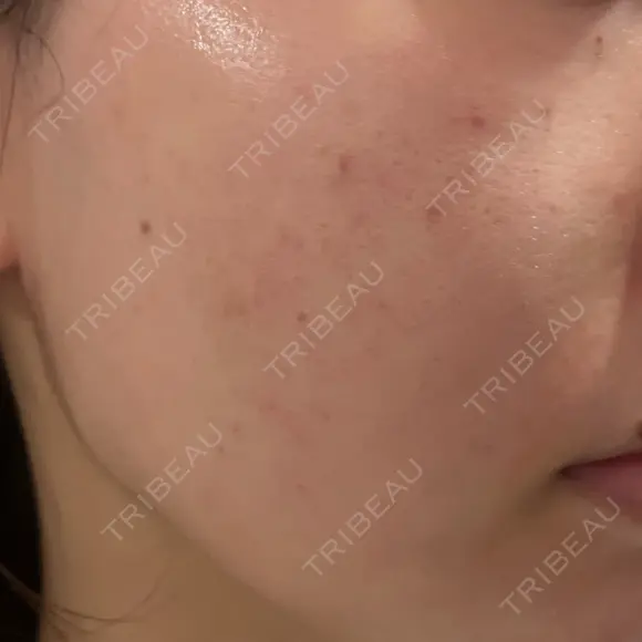 肌育注射（ジュベルックなど） Natural Skin Clinic 自由ヶ丘院 DAY 2 メイン用