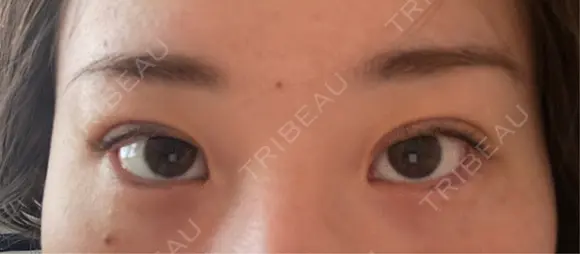 二重埋没 東京シンデレラ美容外科 池袋院 DAY 3 メイン用