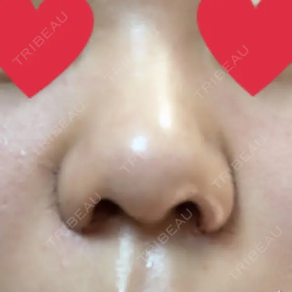 小鼻縮小（切開） ヴェリィ美容形成クリニック AFTER メイン用