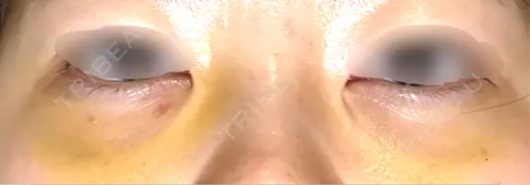 下まぶたの脂肪取り APOLLO BEAUTY CLINIC DAY 7 メイン用