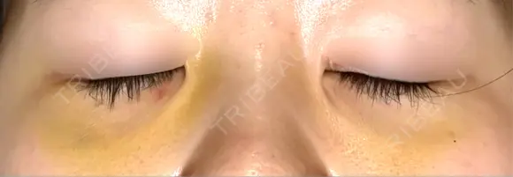 下まぶたの脂肪取り APOLLO BEAUTY CLINIC DAY 7 メイン用