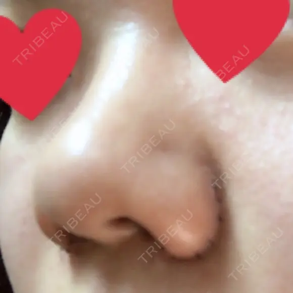 小鼻縮小（切開） ヴェリィ美容形成クリニック DAY 5 メイン用