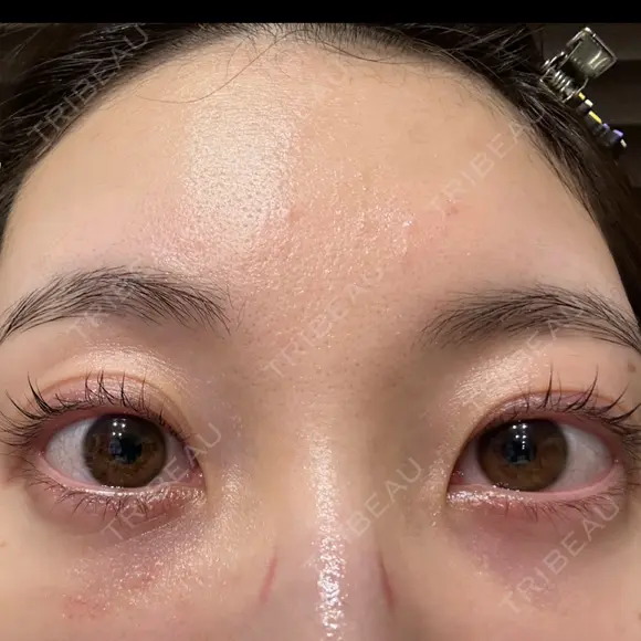 クマ治療 / 下まぶたの脂肪取り APOLLO BEAUTY CLINIC DAY 11 メイン用