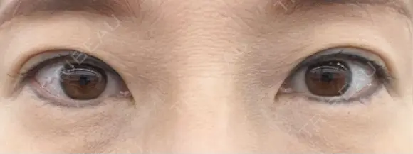 二重埋没 / ヒアルロン酸注入（目の下） アーティスクリニック 博多 AFTER メイン用