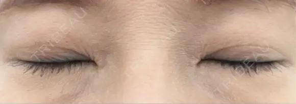 二重埋没 / ヒアルロン酸注入（目の下） アーティスクリニック 博多 DAY 50 メイン用