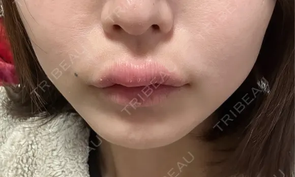 アートメイク（唇） 表参道メディカルクリニック 名古屋院 DAY 3 メイン用