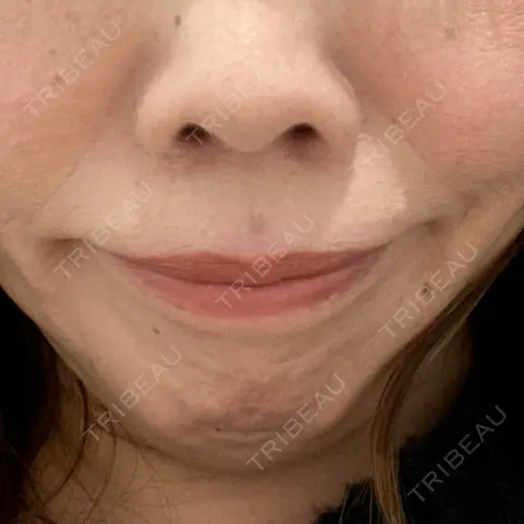 ボトックス（あご） / 肌ヒアルロン酸注入（たるみ・シワ改善） / 高濃度ビタミンC点滴 カジュアルクリニック 平塚院 AFTER メイン用