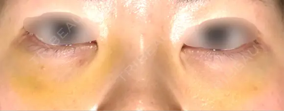 下まぶたの脂肪取り APOLLO BEAUTY CLINIC DAY 8 メイン用