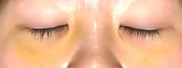下まぶたの脂肪取り APOLLO BEAUTY CLINIC DAY 8 メイン用