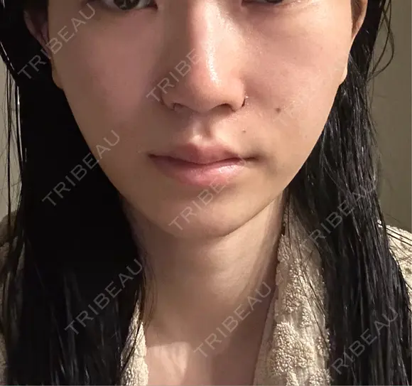 小鼻縮小（切開） くさのたろうクリニック DAY 5 メイン用