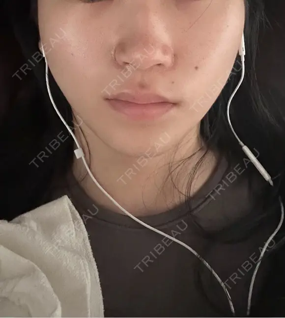 小鼻縮小（切開） くさのたろうクリニック DAY 7 メイン用