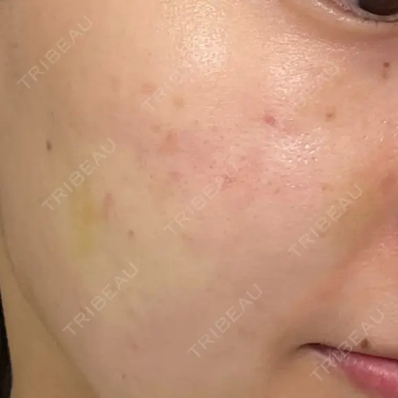肌育注射（ジュベルックなど） Natural Skin Clinic 自由ヶ丘院 DAY 3 メイン用