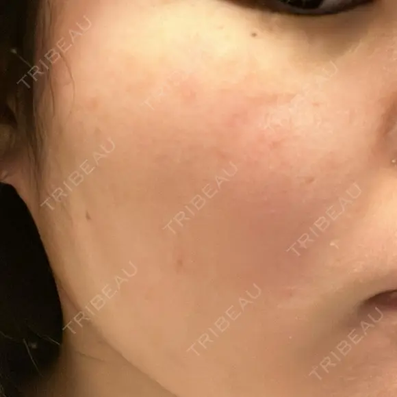 光治療（フォトフェイシャルなど） 81clinic DAY 2 メイン用