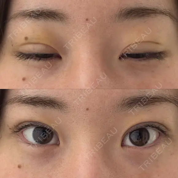 二重埋没 東京シンデレラ美容外科 池袋院 DAY 5 メイン用