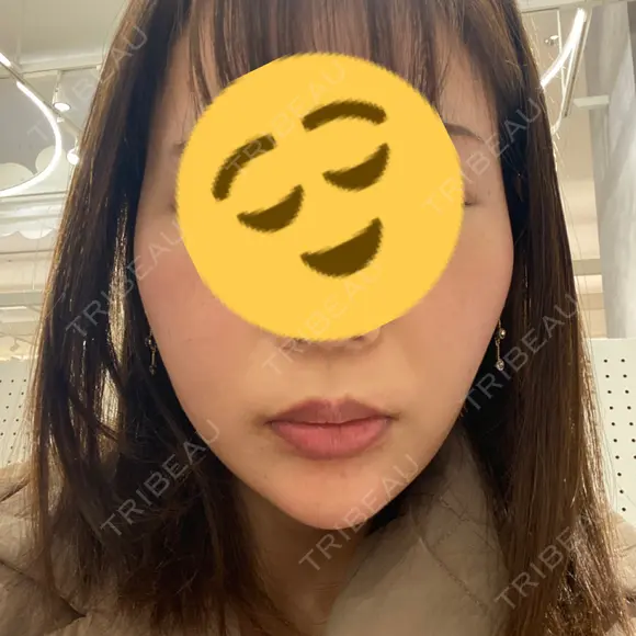 ハイフ（顔） 表参道メディカルクリニック 新宿院 DAY 0 メイン用